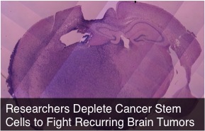 glioblastoma brain tumor depletion of cancer stem cells
